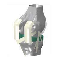  Tibiofemoral Constraint: Measure laxity of the fibiofemoral joint with soft tissue using the Tibiofemoral Constraint workflow in the Abaqus Knee Simulator.